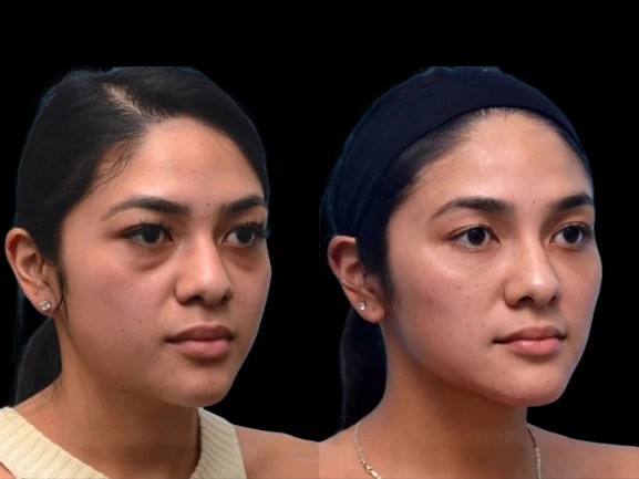 Are Dark Circles Genetic Insights from the Best Doctors in Dubai