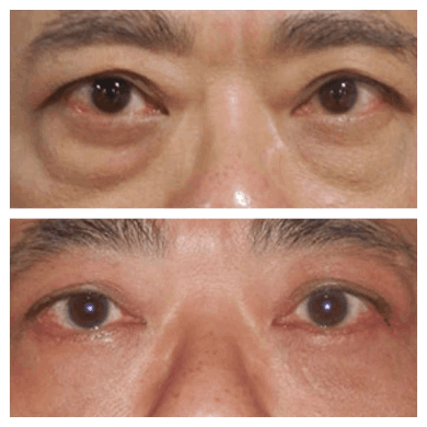 What Causes Eye Bags? Solutions Recommended by Best Doctors in Dubai
