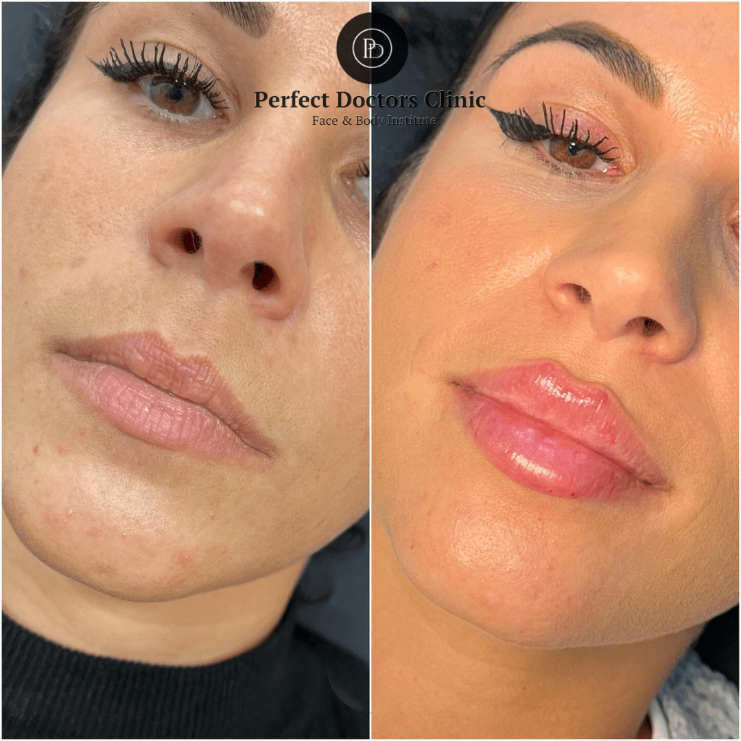 Juvederm Microdroplet Technique: Used by the Best Doctors in Dubai
