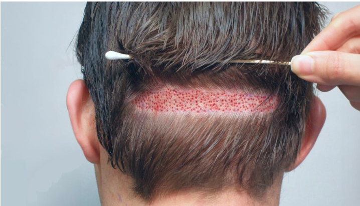 How Hair Transplant Works: Expert Insights from Dr. Burhan Ashraf