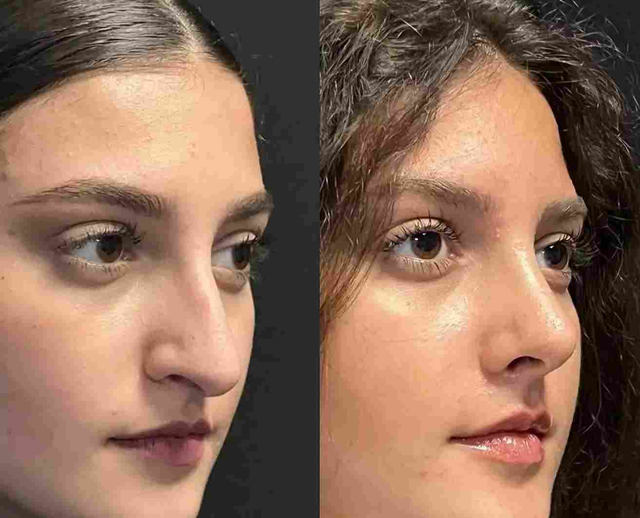 Best Rhinoplasty Surgeons in Dubai: A Complete Patient-Focused Guide