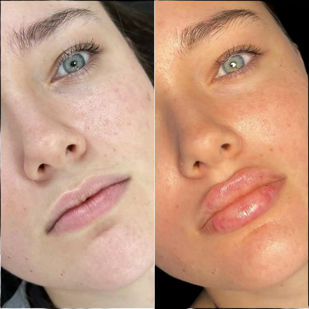 Best Plastic Surgeon in dubai for Fillers Offering Natural Facial Harmony