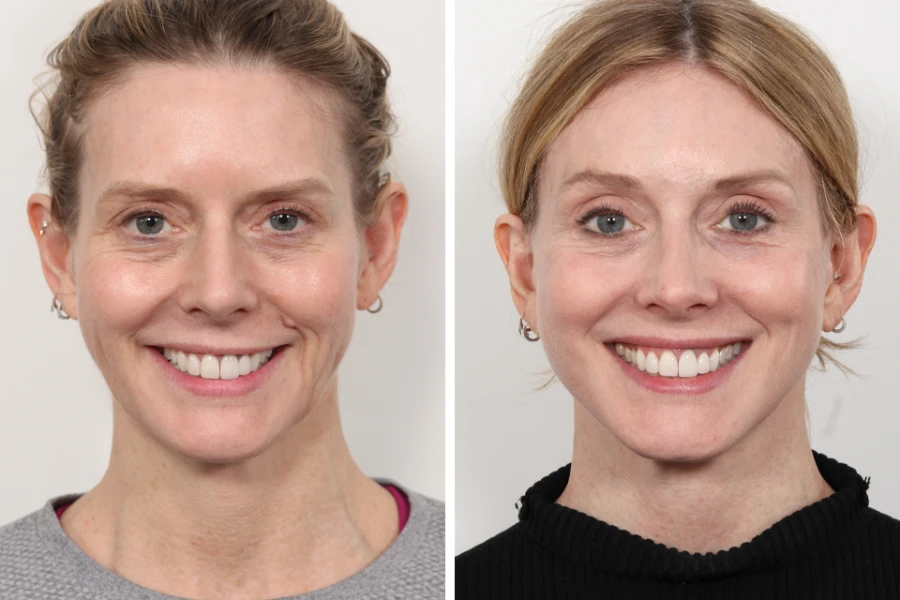 Best Doctors in dubai for Thread Lift with Subtle Elegance