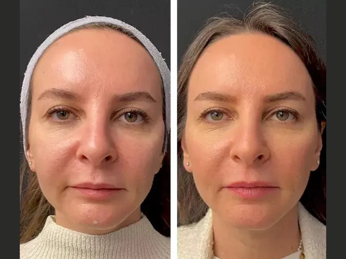 How Lifestyle Impacts Results of Mesotherapy Treatments in Dubai