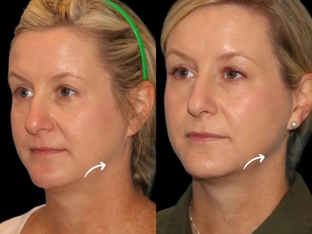 Sculptra Fillers Treatments in Dubai and NDA Patients