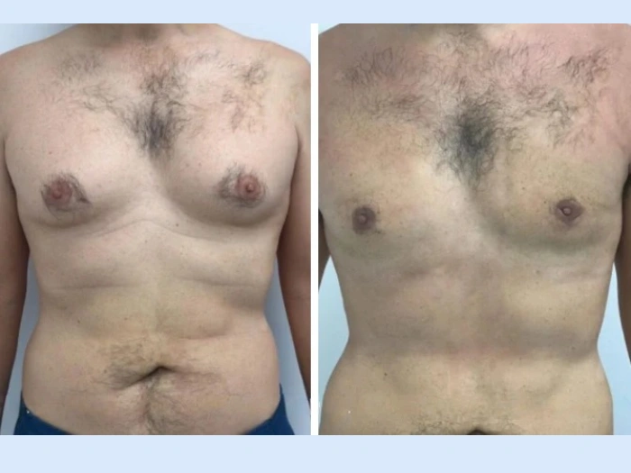 Surgical Approaches to Gynecomastia Used by Best Doctors in Dubai