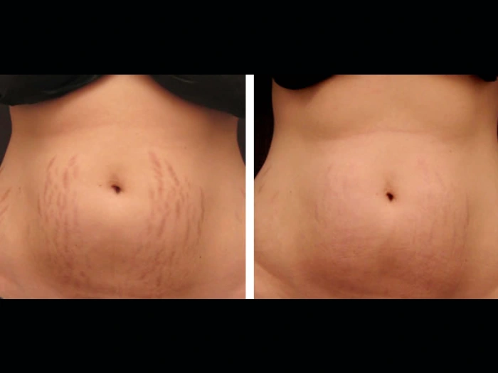 How to Choose Radiofrequency (RF) Microneedling Best Doctors in Dubai