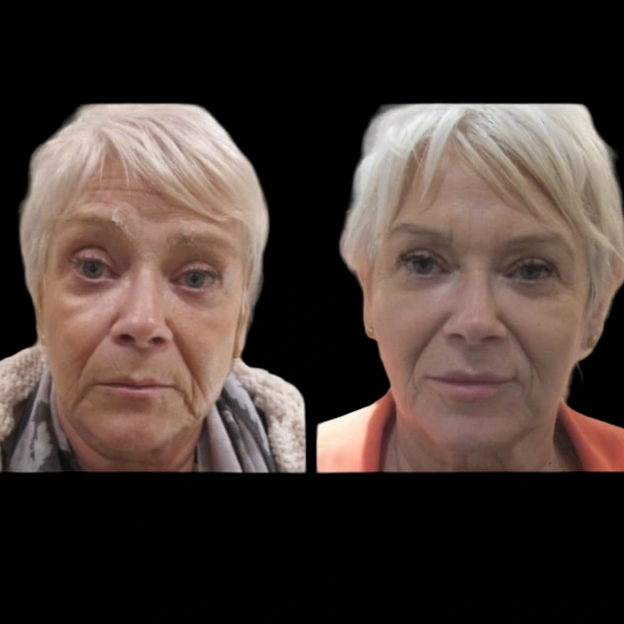 How the Best Aesthetic Clinic in Dubai Handles Jawline Fillers Touch-Ups