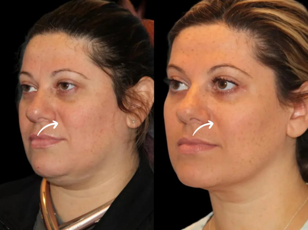 Best Doctors in Dubai for Minimal Swelling Sculptra
