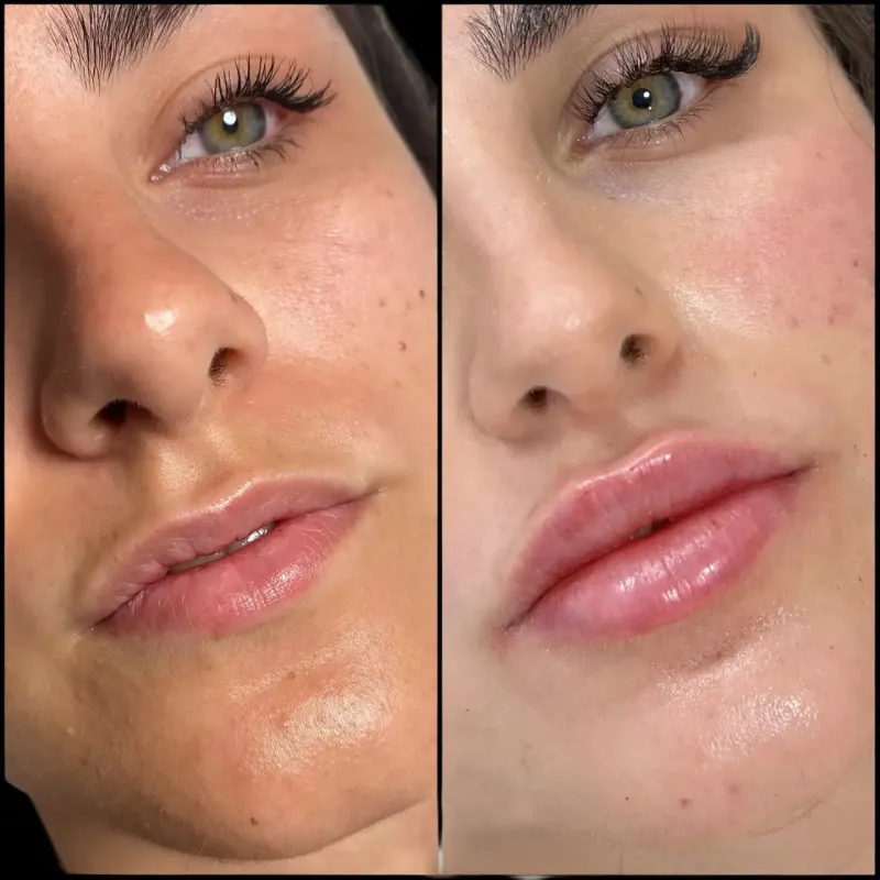 Best Dermal Fillers Doctors in Dubai for Radiant Results