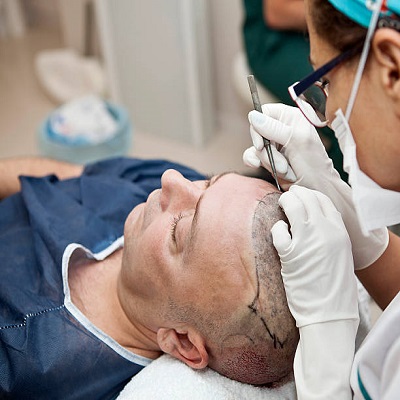 How Successful Are Hair Transplants in Riyadh? Key Factors Explained