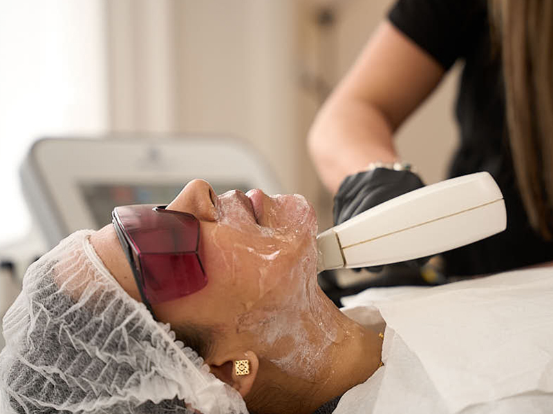 Laser for Rosacea in London: Proven and Effective Treatments to Reduce Redness and Sensitivity