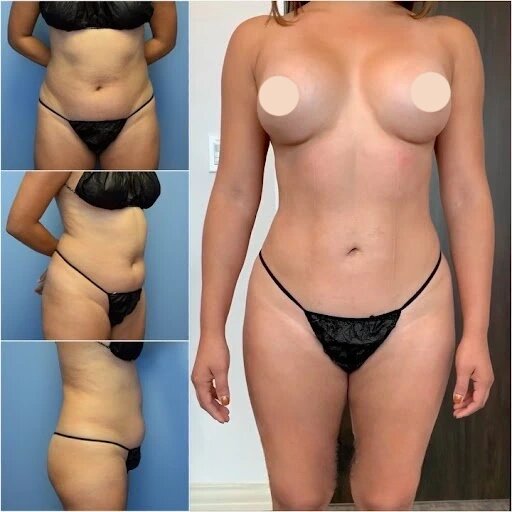Perfecting Proportions with the Best Body Contouring Surgeon in Dubai