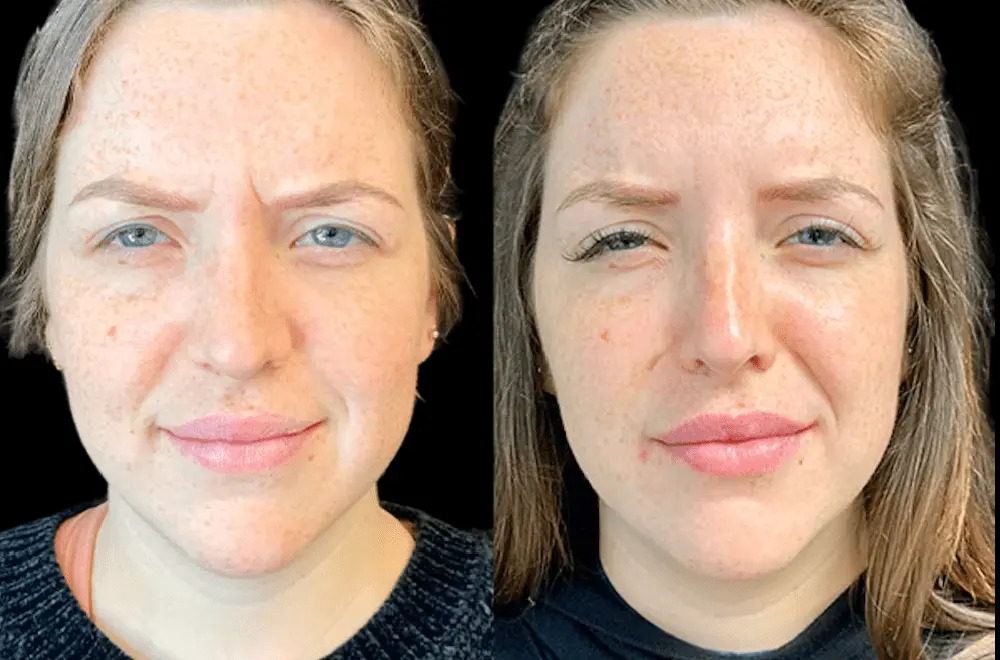 How Climate and Lifestyle Affect Botox Treatment in Dubai Results