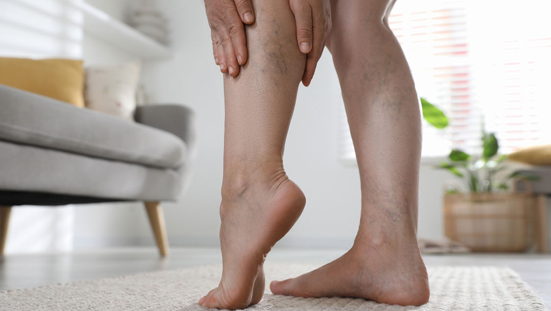 Why Choose Manchester for Spider Vein Removal