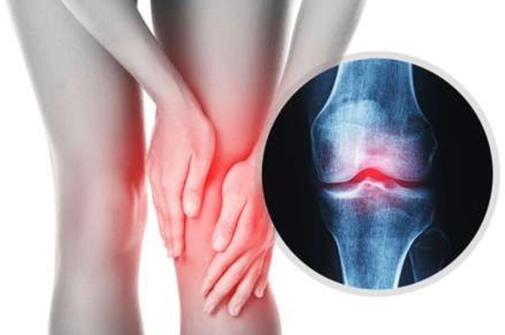 Genicular Artery Embolization