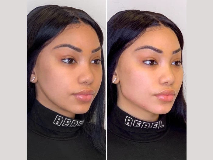 Experience Natural Lifting with Thread Lift at the Best Aesthetic Clinic in Dubai