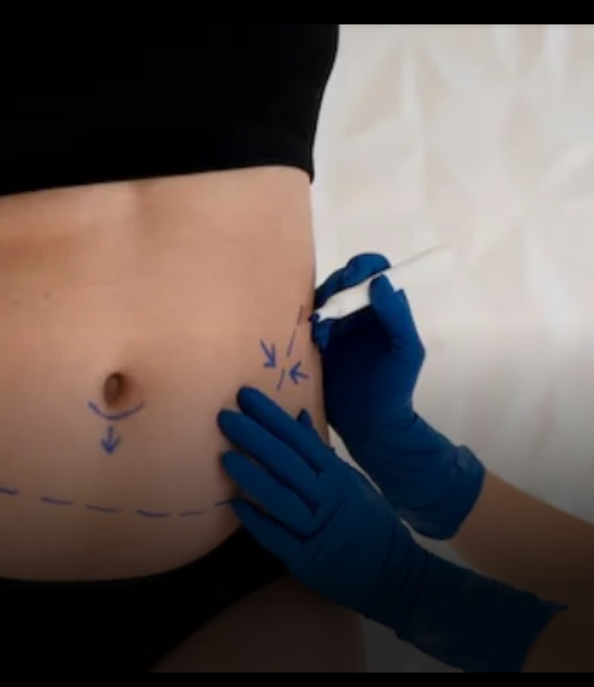 Abdomen Liposuction in Dubai – A Leading Cosmetic Procedure