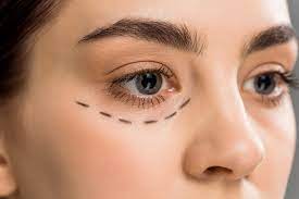 Eyelid Bag Surgery Dubai: Recovery and Healing Timeline