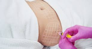 Where Can You Get Safe Fat Dissolving Injections in London?