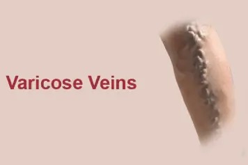 Advanced Non-Surgical Treatments for Varicose Veins