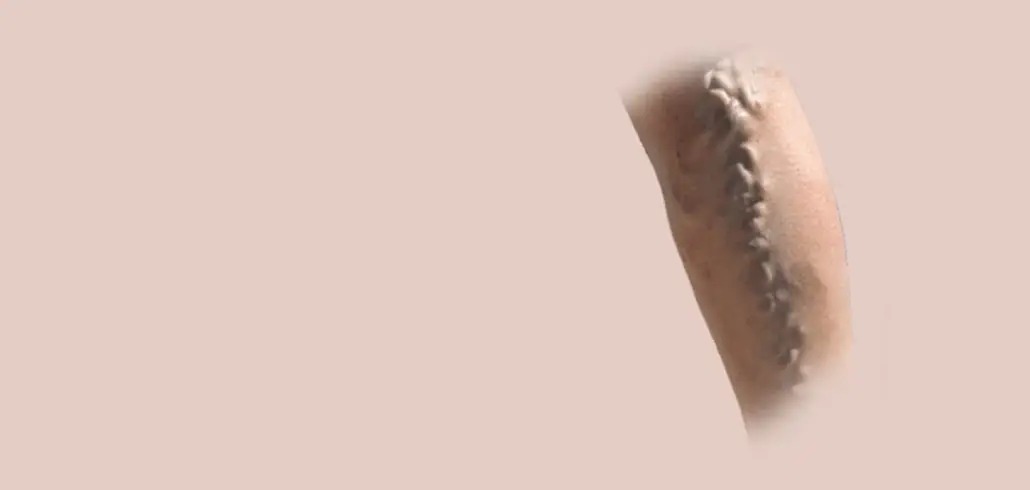 Varicose Veins Treatment