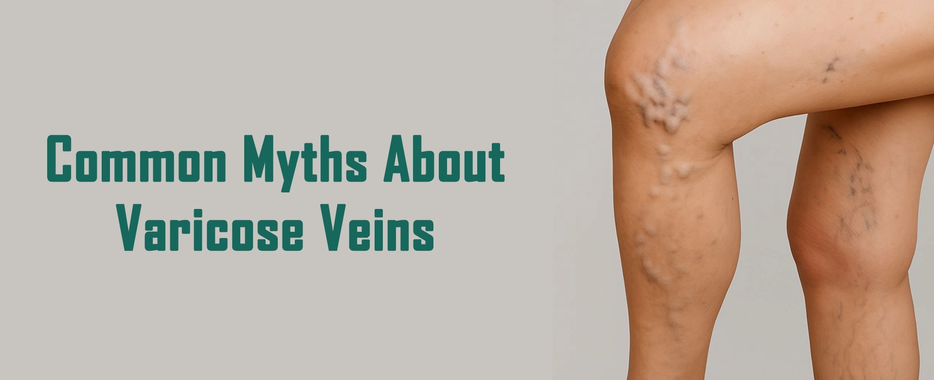 Varicose Veins Treatment
