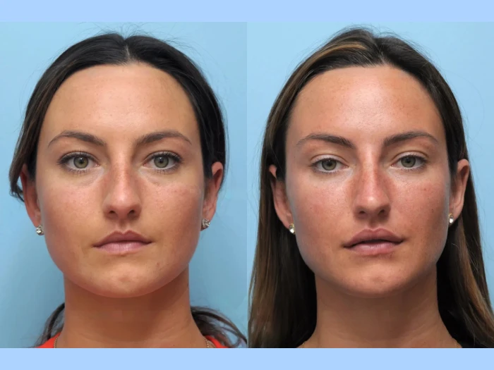 The Secret to Youthful Firm Skin Best Doctors in Dubai for Thread Lift