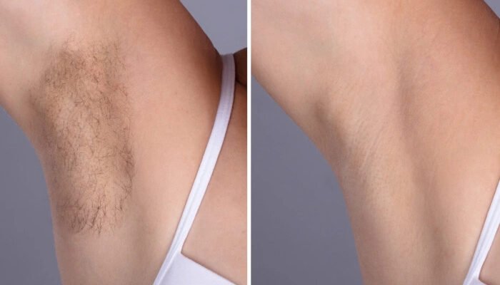 Laser Hair Removal Treatments in Dubai: Why It’s Worth the Investment