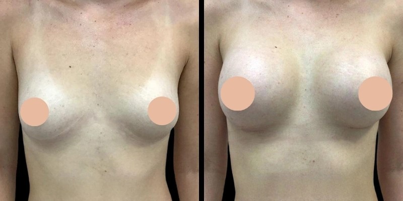 Best Doctors in Dubai: Advanced Technologies in Modern Breast Enhancement